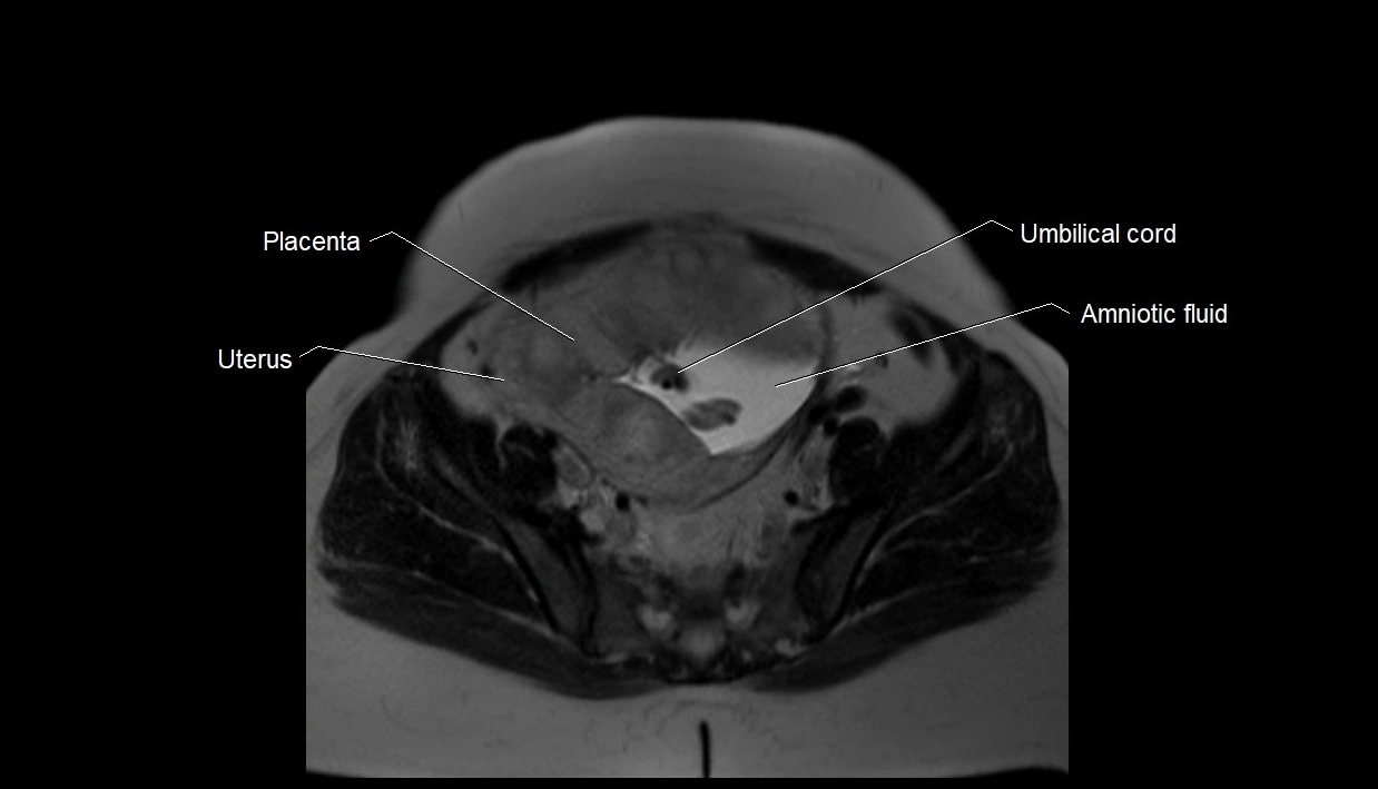 MRI fetal anatomy axial image 30.webp